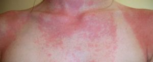 projevy alergie na pokožce