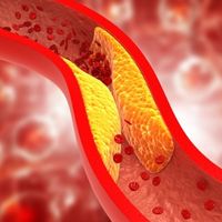 artyčok a snížení hladiny cholesterolu