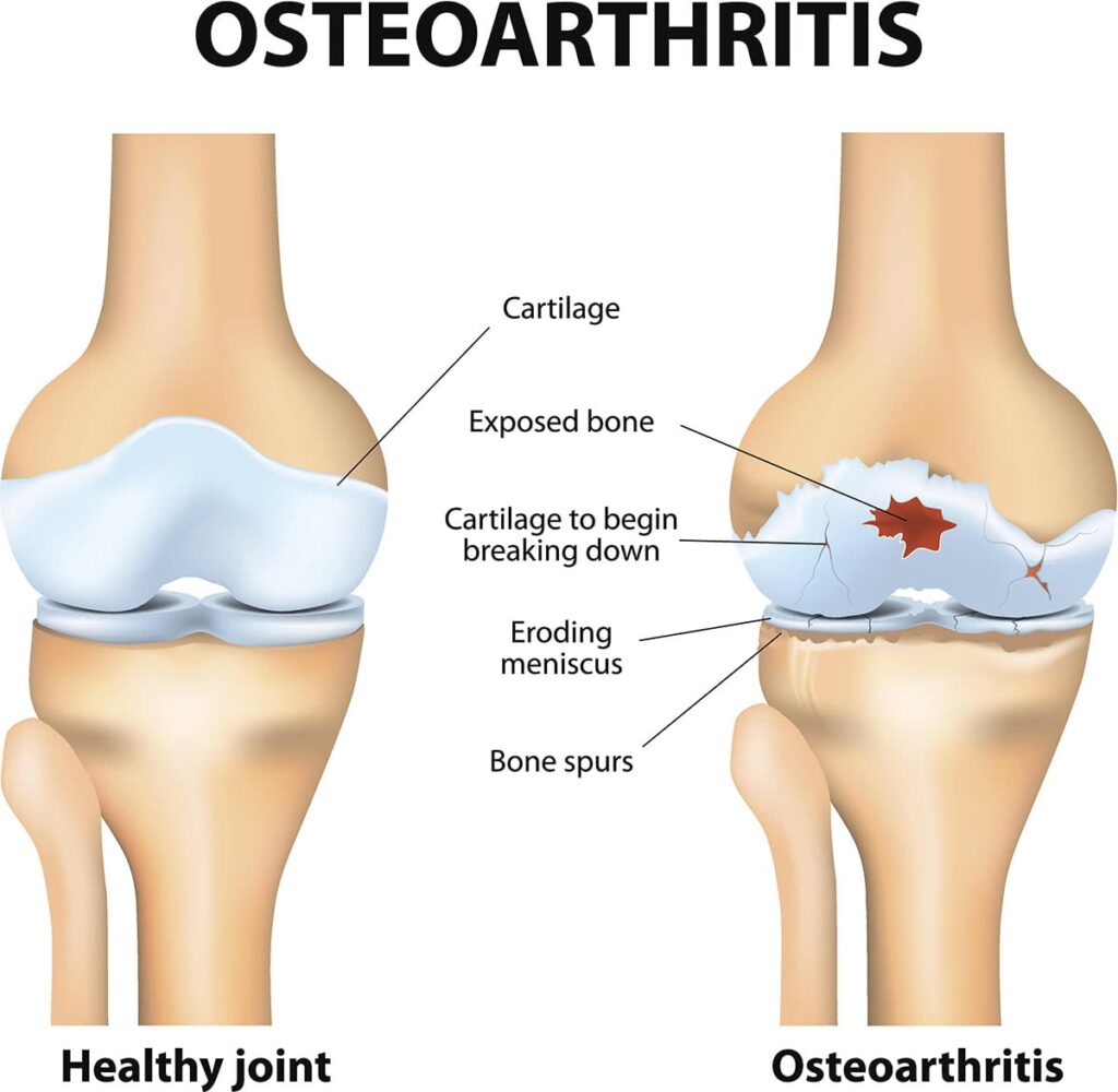 osteoartritida